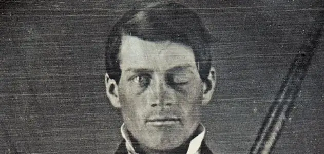Phineas Gage: o homem que sobreviveu com barra de ferro no crânio