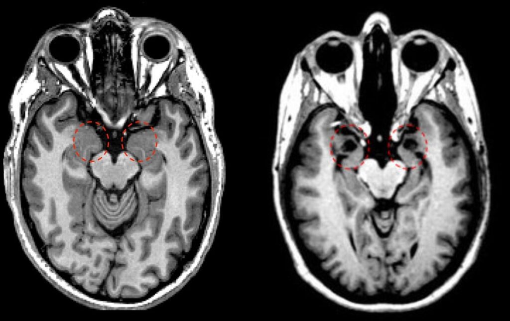 Urbach+wiethe+disease+amygdala+damage Urbach-Wiethe